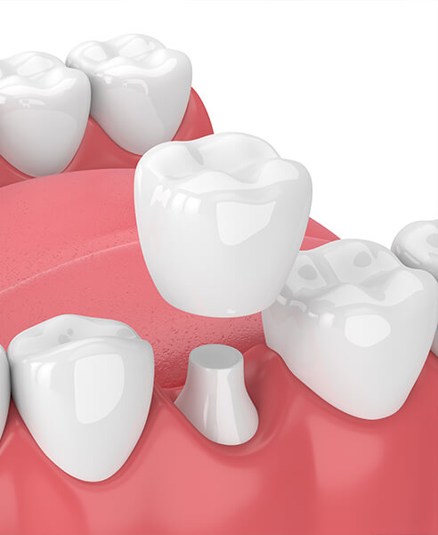 illustration of a dental crown