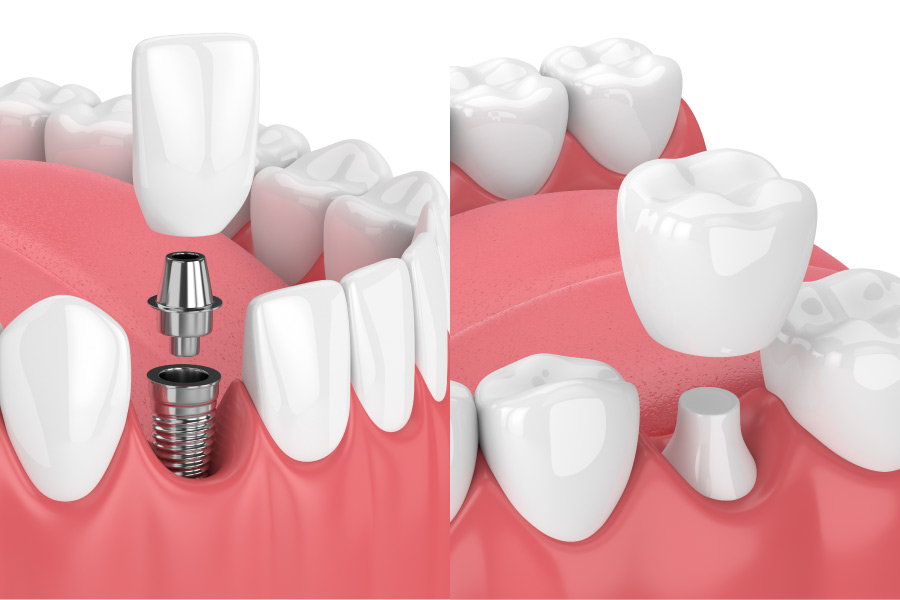 Side-by-side images showing a dental crown on an implant and capping a natural tooth to restore the smile