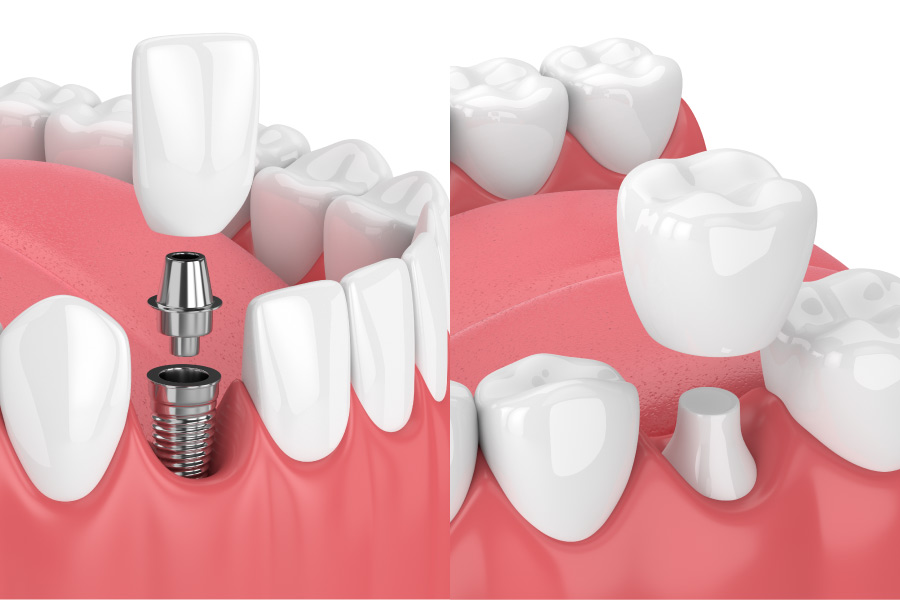 How Dental Crowns Can Restore Your Smile