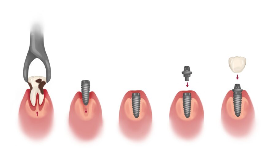 Technical graphic illustration of dental implants process.