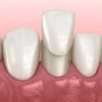 Mandibular Veneer installation procedure over lateral incisor. Medically accurate tooth 3D illustration