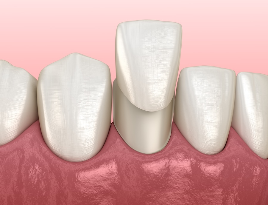 Mandibular Veneer installation procedure over lateral incisor. Medically accurate tooth 3D illustration