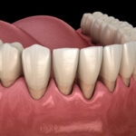 gum disease stages, periodontal disease, deep cleaning