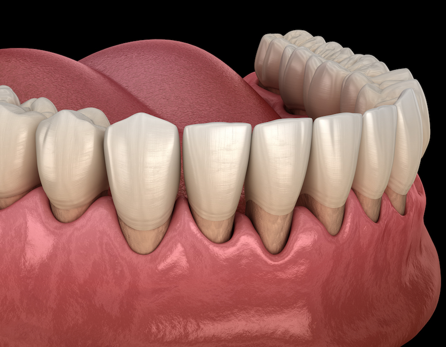 gum disease stages, periodontal disease, deep cleaning