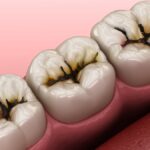 dark spots on teeth, tooth discoloration, Beaufort Center for Dentistry, Dr. Louis Costa III, dental care, tooth decay, dental stains, tooth trauma
