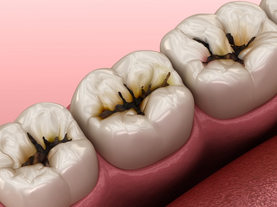 dark spots on teeth, tooth discoloration, Beaufort Center for Dentistry, Dr. Louis Costa III, dental care, tooth decay, dental stains, tooth trauma