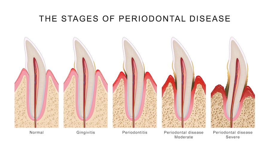 infographic of the stages of gum disease or periodontal disease for when a deep cleaning is needed